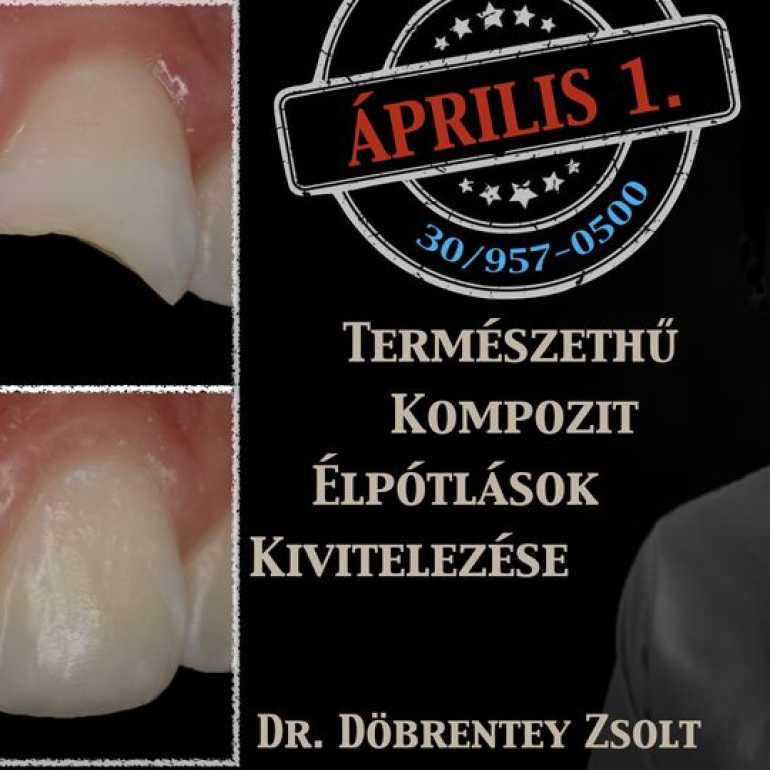 Természethű kompozit élpótlások kivitelezése – Tippek és trükkök a tervezhető siker érdekében