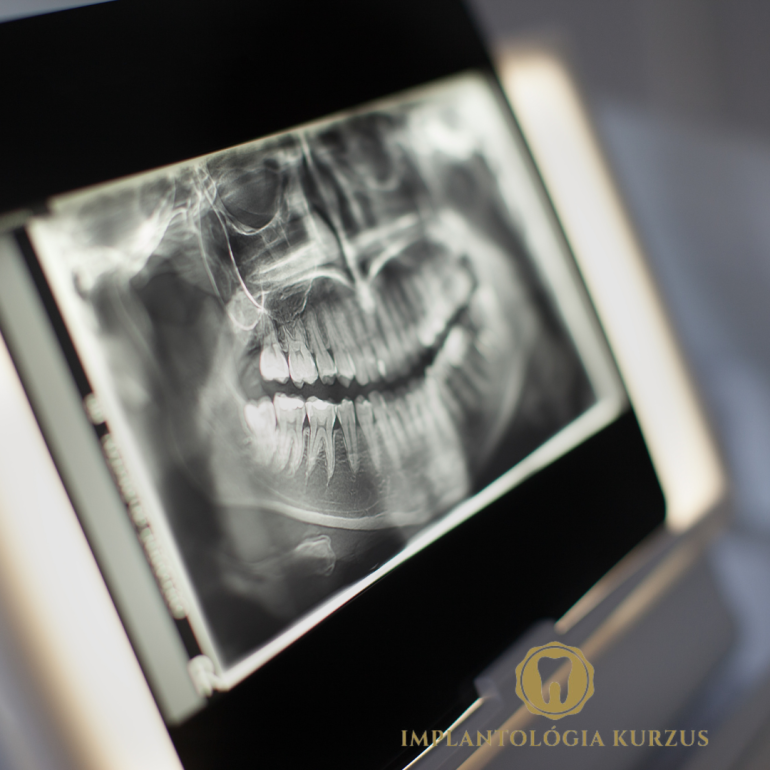 Az alapoktól a mester fokozatig! 10 napos orális implantológiai kurzus. 1. rész